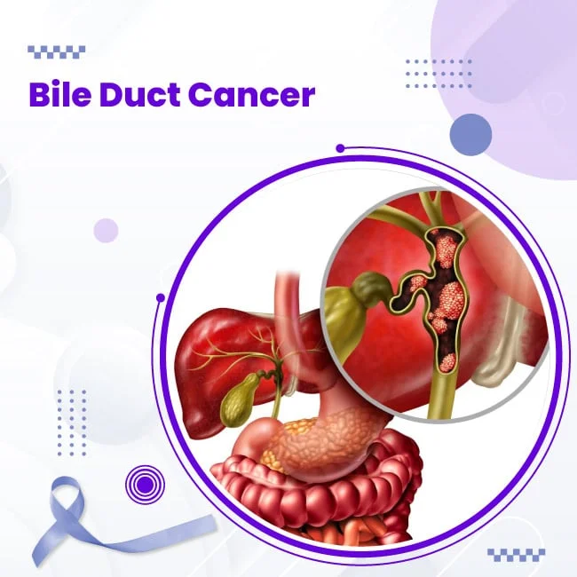 Antwort What Happens In The Final Stages Of Bile Duct Cancer Weitere antwort-what-happens-in-the-final-stages-of-bile-duct-cancer-weitere