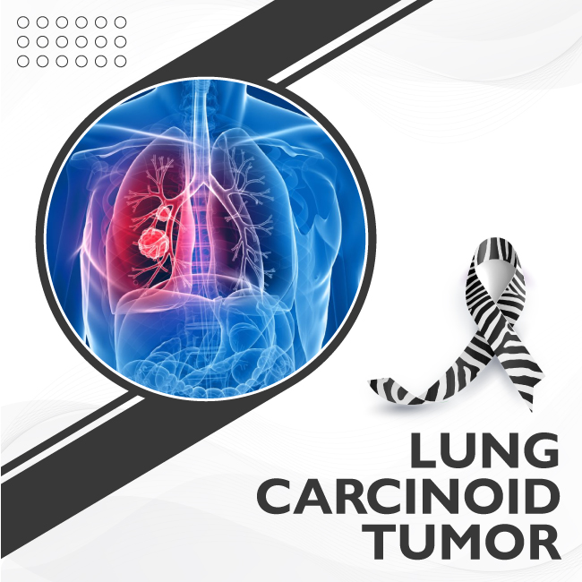 Lung Carcinoid Tumor
