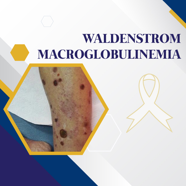 Waldenstrom Macroglobulinemia