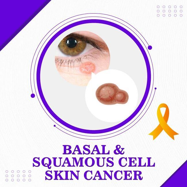 Basal and Squamous Cell Skin Cancer